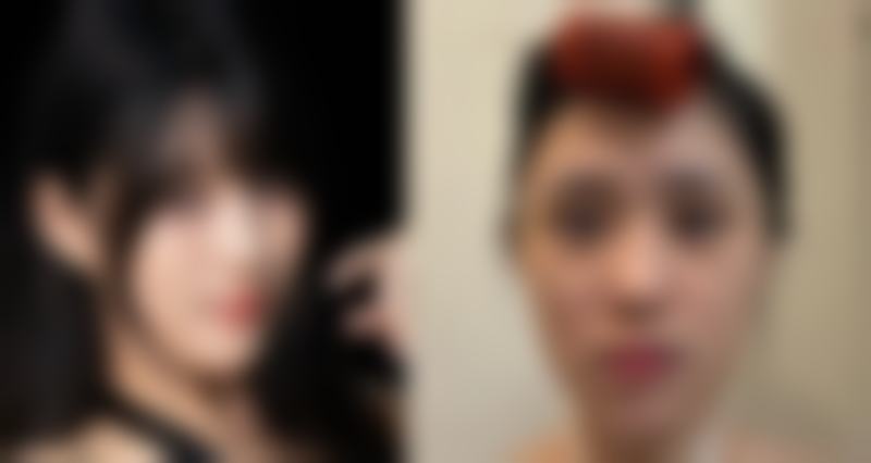 五、抚顺陈彩蓓整形医院真实实例参考