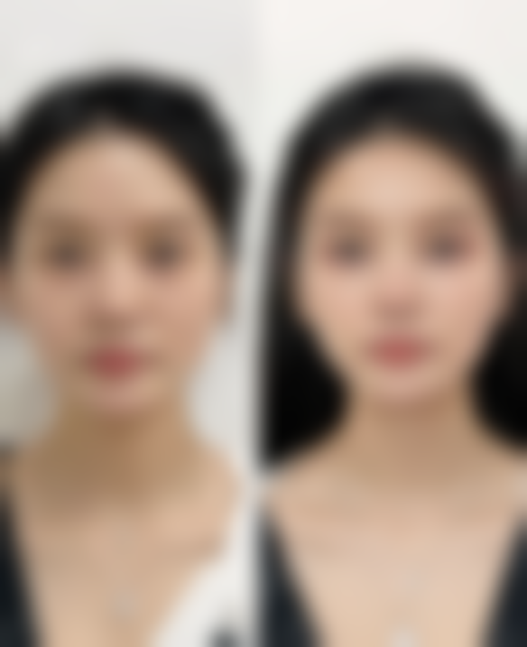 什么方法去除眼袋快？手术治疗立竿见影，激光、注射填充也不错，日常护理做辅助！ 