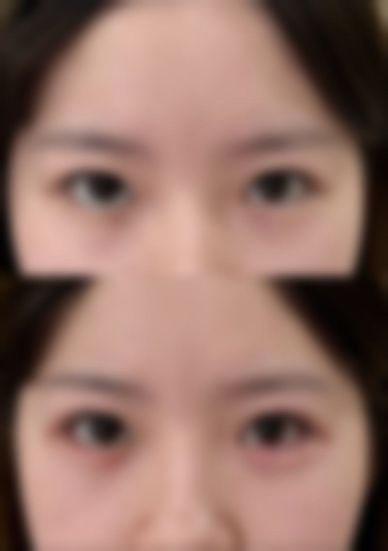 手术治疗：重度眼袋的有效解决方案