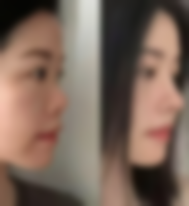 药物治疗：对症下药，消除炎症性眼袋