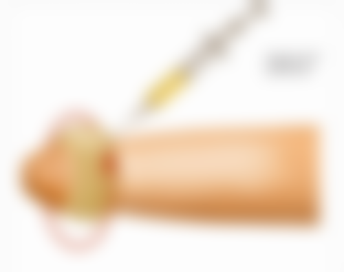 填充治疗：注入活力让凹陷肌肤饱满起来