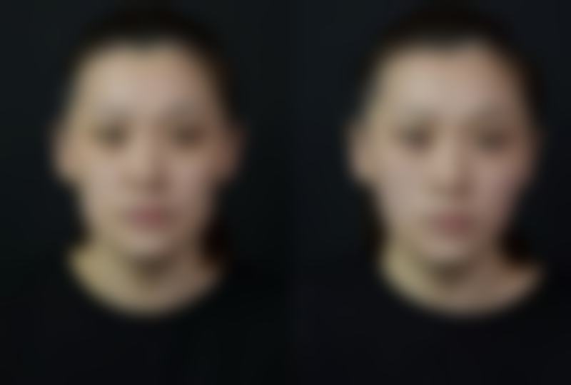 点痣留下凹陷疤痕如何去除？可根据凹陷程度选方法，轻度用药物，中重度用激光或填充！ 