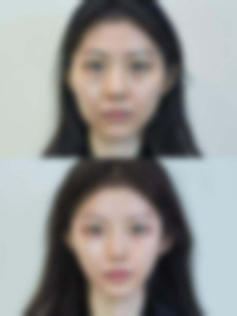 医疗技术大比拼：不同植发技术对成效维持的影响