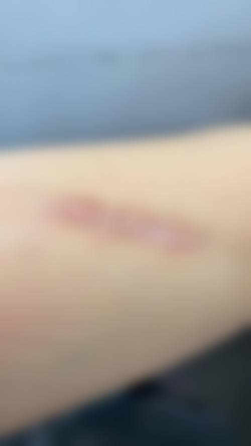 严东玲医生技术优势