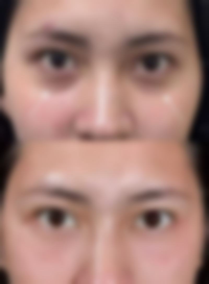 外切法去眼袋手术全流程修复时间