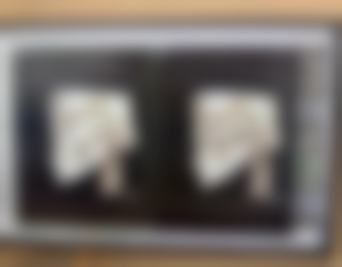 假体隆胸取出风险大吗？其实风险可控，选好医生和假体、做好护理，能大大降低风险！ 