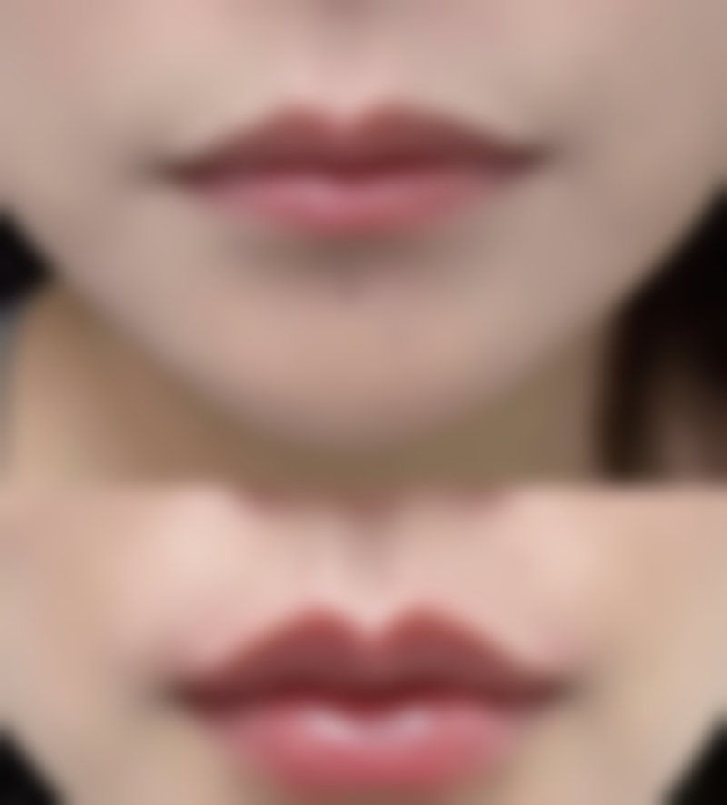 激光治疗：微创去除轻度眼袋