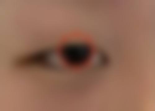 如何缩短假体隆胸修复自然的时间