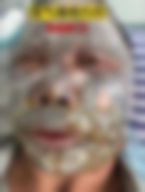 沈阳做疤痕修复哪家医院好？沈阳军区总医院、美莱医美技术优且口碑好可预约！ 