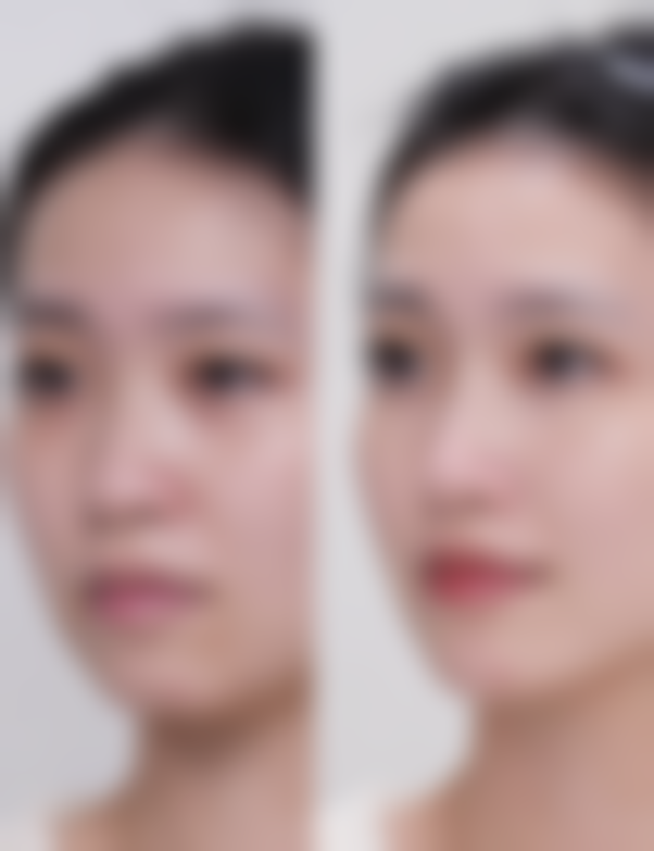 哪些情况适合做双眼皮二次手术？