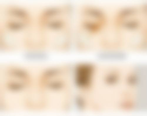 加格达奇双眼皮手术理性避坑指南