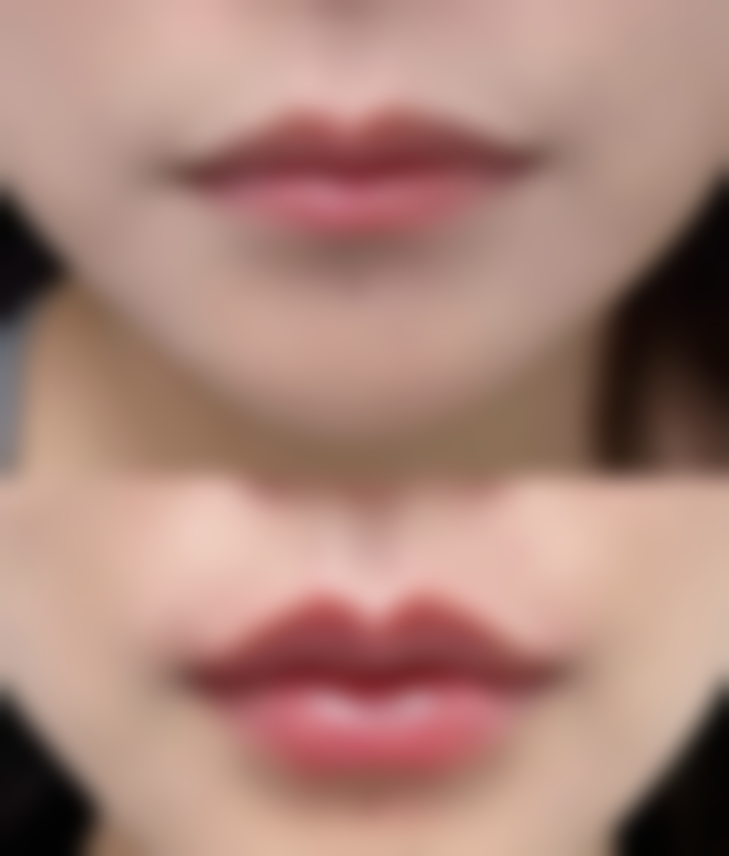 特殊情况：难以自行修复的凹陷