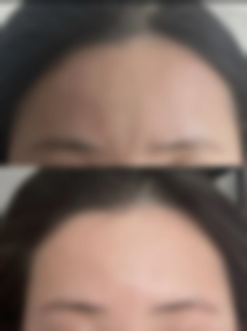 轻薄针诊疗优势解析