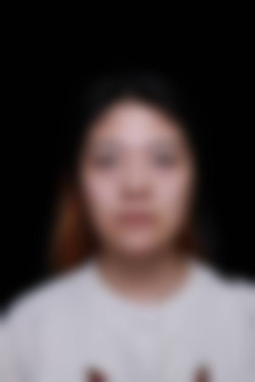 专精去除眼袋：激光与手术的神奇成效