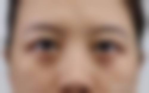 选择专精医生和医院，让内切眼袋修复更顺利