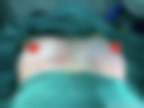 技术与操作失误对隆胸持久性的重度影响