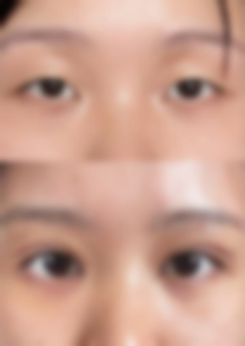 眼睛肿了双眼皮变小了怎么办？可能是睡前饮水多、过敏等，可冷敷、用药或调整作息恢复！ 