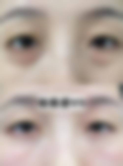 从实际实例探究美妍高科去眼袋副作用