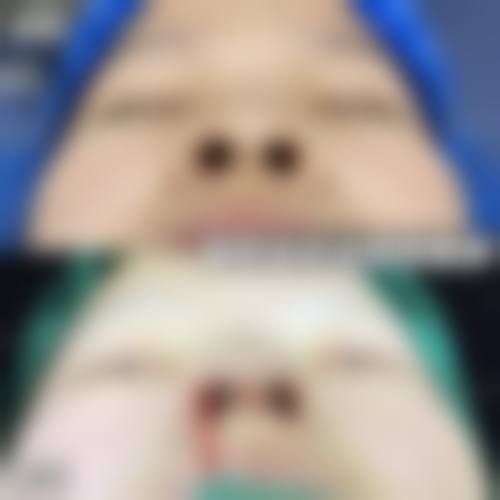 热玛吉技术优势