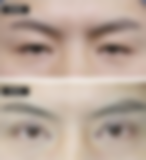 做完全切双眼皮不能吃过敏食物