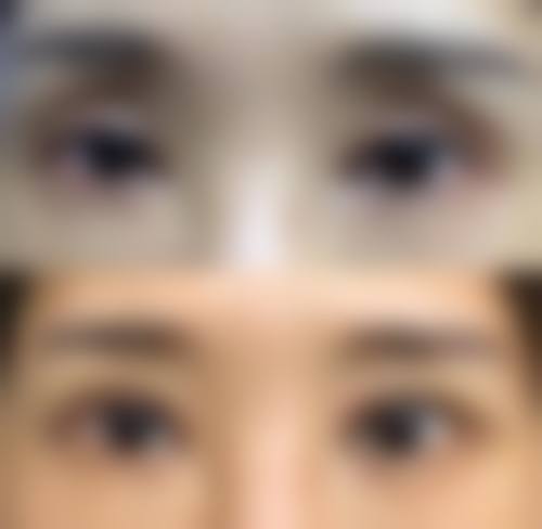 隆鼻项目：塑造挺拔美鼻的理想之选