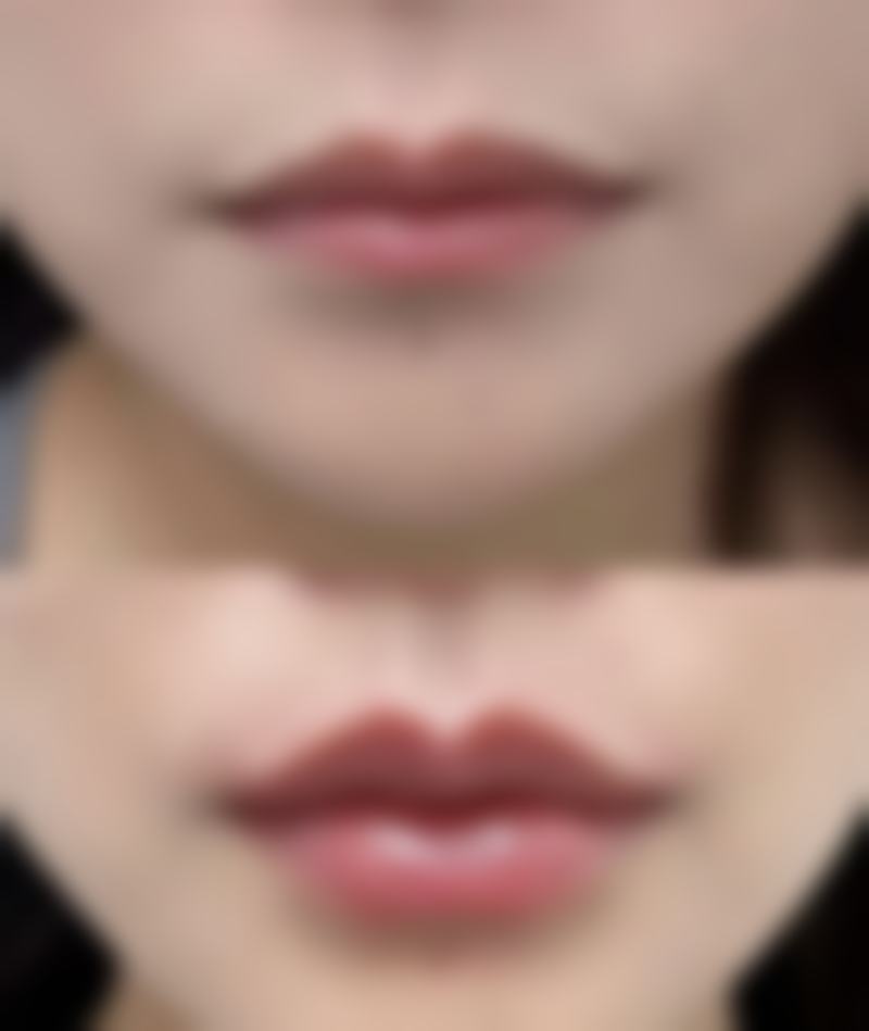 成都美立方医疗美容医院：专精团队塑造甜美酒窝