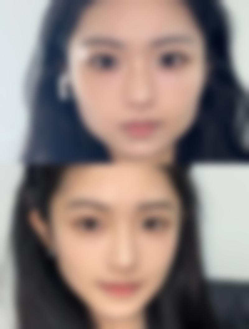 谢宏彬拉皮价格：受多种因素影响