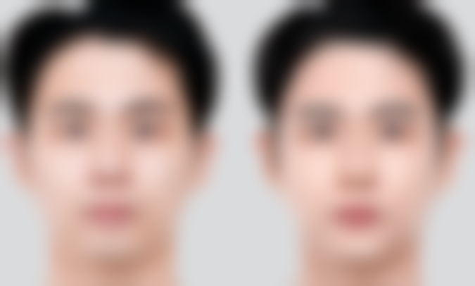 全切双眼皮饮食修复的注意事项总结