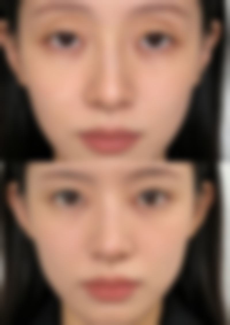 全切双眼皮多久可以正常饮食？一般1 - 3个月，具体看恢复情况！ 