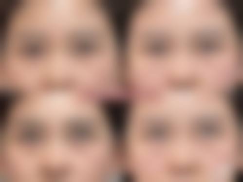 综合比较割眼袋和嗨体注射去除眼下细纹