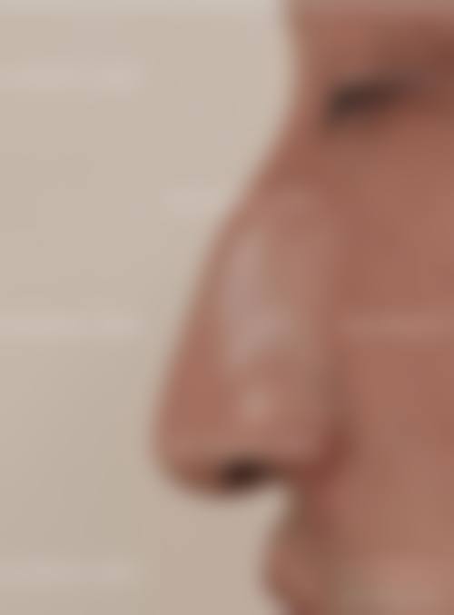 四、刘金超医生的鼻整形手术优势在哪？