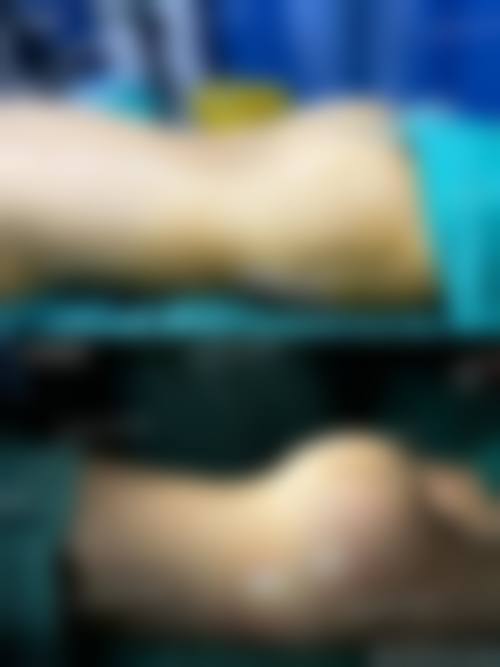 东莞华美医疗美容整形门诊部的双眼皮手术风波