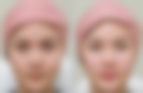 经验多医生操作减少埋线危害