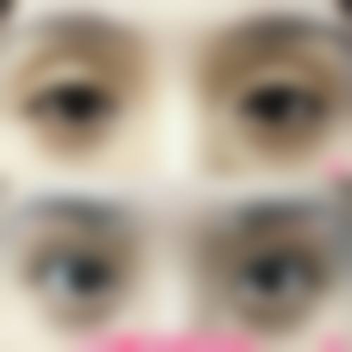 三、雷中元的自体软骨隆鼻技术好在哪？