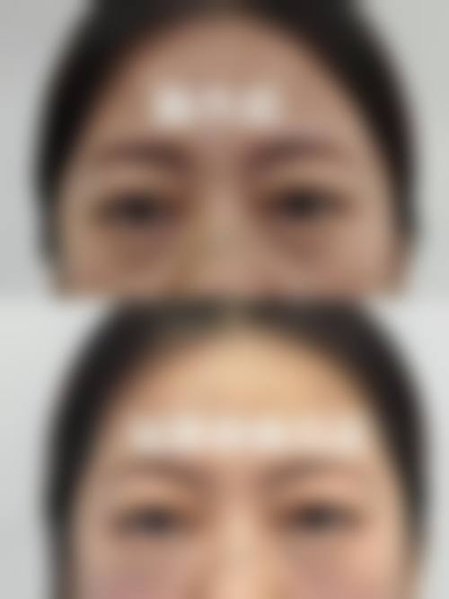 西安开双眼皮哪家医院做得好？服务贴心的医院分享