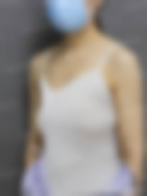 如何降低注射玻尿酸隆胸副作用的风险