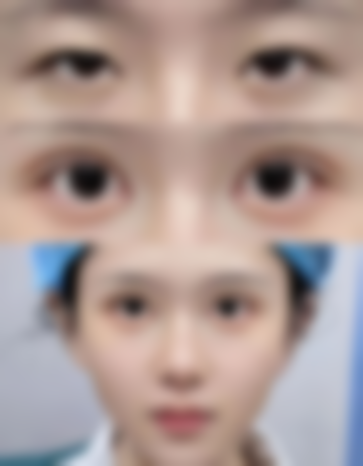 做双眼皮注意什么：术后防感染特别重要