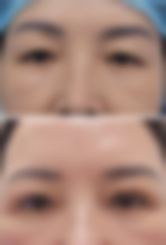 做双眼皮注意什么：术前准备事项要记牢