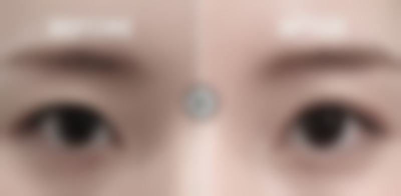 不同双眼皮术式的优势