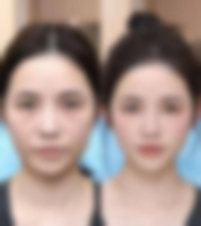 做双眼皮注意什么：术后合理用眼需重视