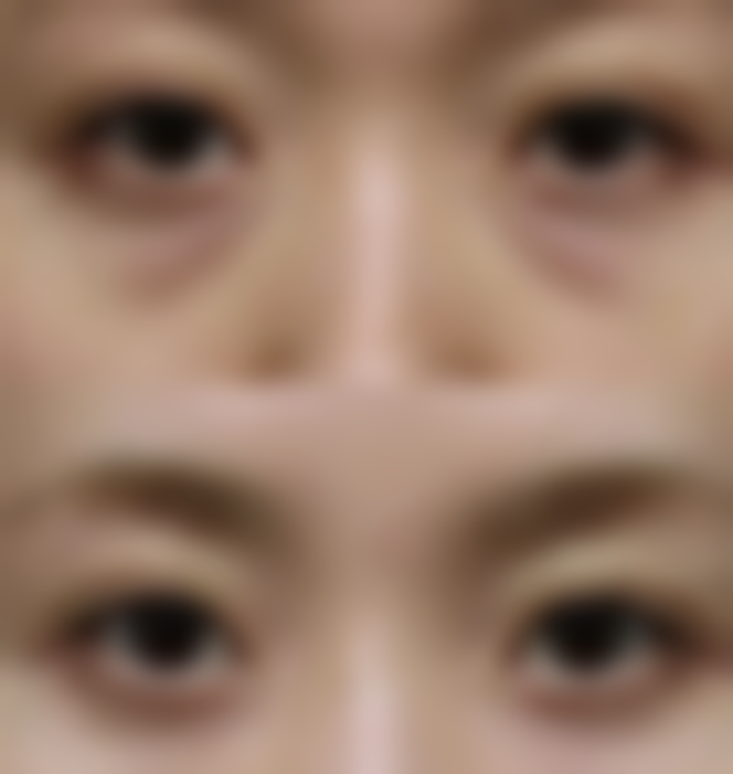 雷中元：合肥奥美医疗美容门诊部医师，凭自体软骨隆鼻成“自然美鼻奥美鼻名医” 