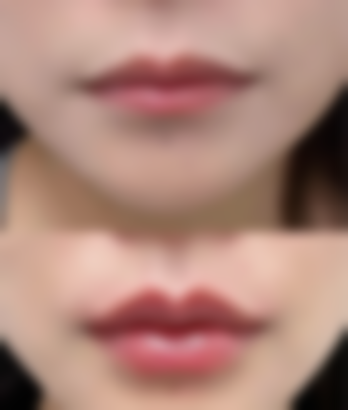 医院选择对注射玻尿酸隆胸副作用的影响