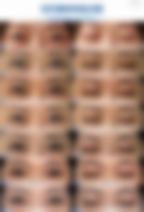 广州韩妃李光琴双眼皮手术的术前术后照片对比，展现自然对称效果与快速变好优势！ 