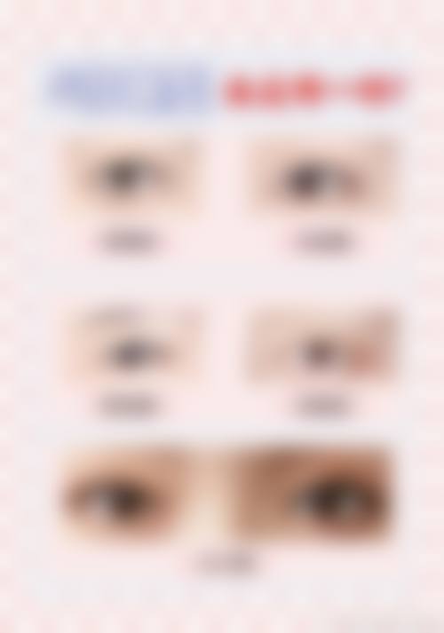 割双眼皮为什么早上起来看起来很肿？原来是手术刺激、感染及睡眠姿势等因素所致！ 