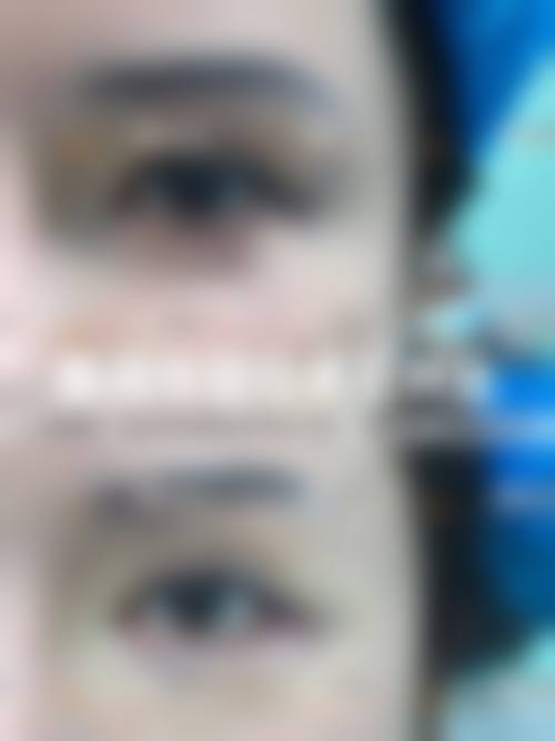 割双眼皮早上起来特别肿的睡眠姿势因素