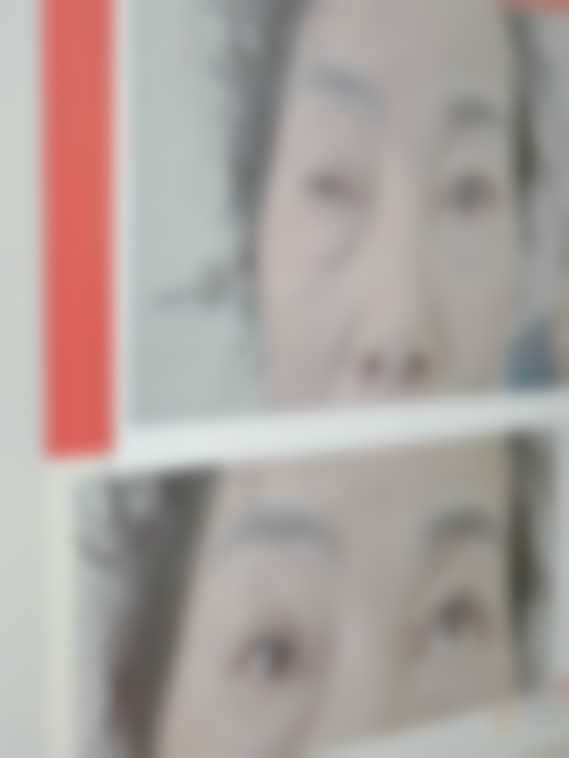 割双眼皮早上起来特别肿的注意事项