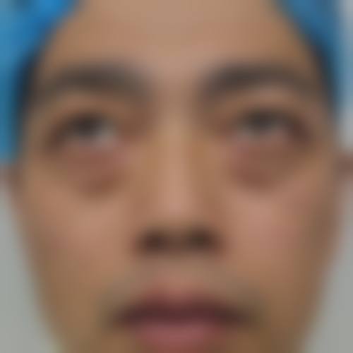 激光治疗消除眼袋