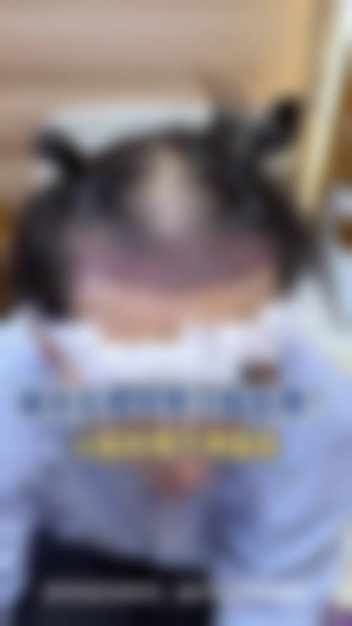 兰州新禾植发的项目与价格