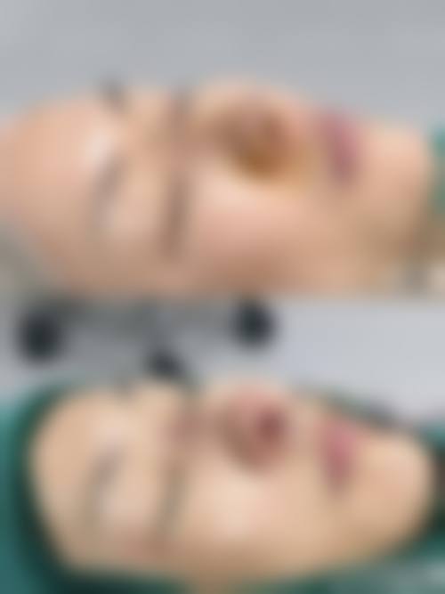 隆鼻可以做二次吗？可以，但要在专业医生评估下进行，且术后需严格遵医嘱护理以降低风险！ 