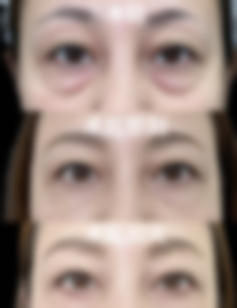 手术切除消除眼袋